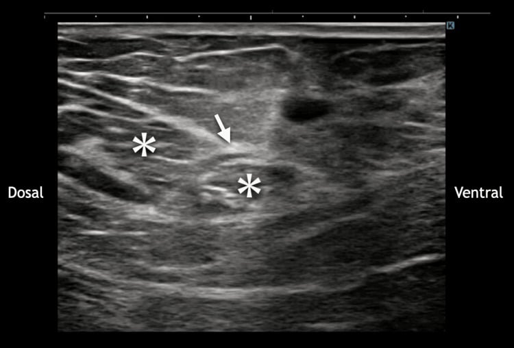 Short-axis ultrasound showing the infrapatellar branch of the saphenous nerve penetrating the sartorius muscle.