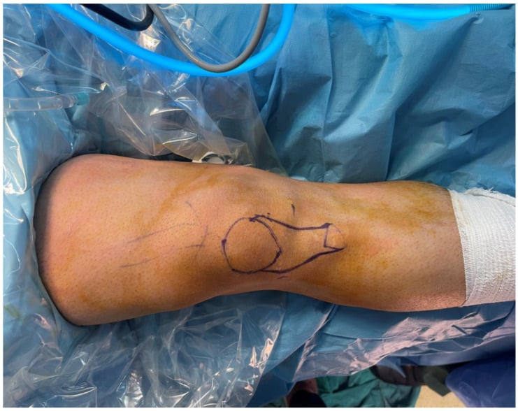 Draped medial knee with preoperative skin marking of the patella, joint line and hamstring harvest landmarks.