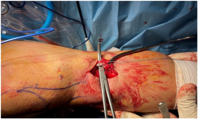 Operative photograph showing semitendinosus and gracilis tendons being prepared with Krackow sutures during hamstring harvest.