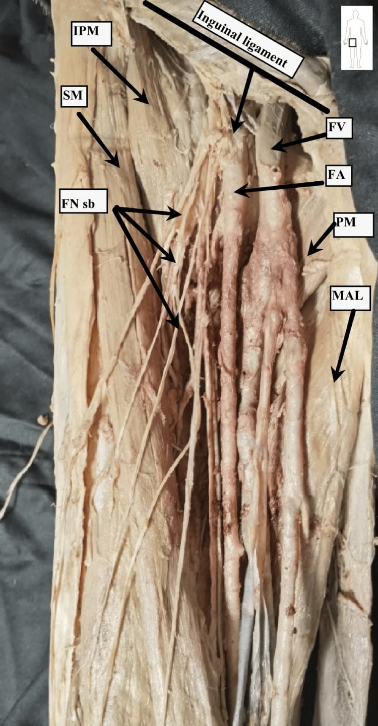 Cadaveric right femoral triangle dissection labelled with sartorius, adductor longus, femoral artery and femoral nerve branches beneath the inguinal ligament.