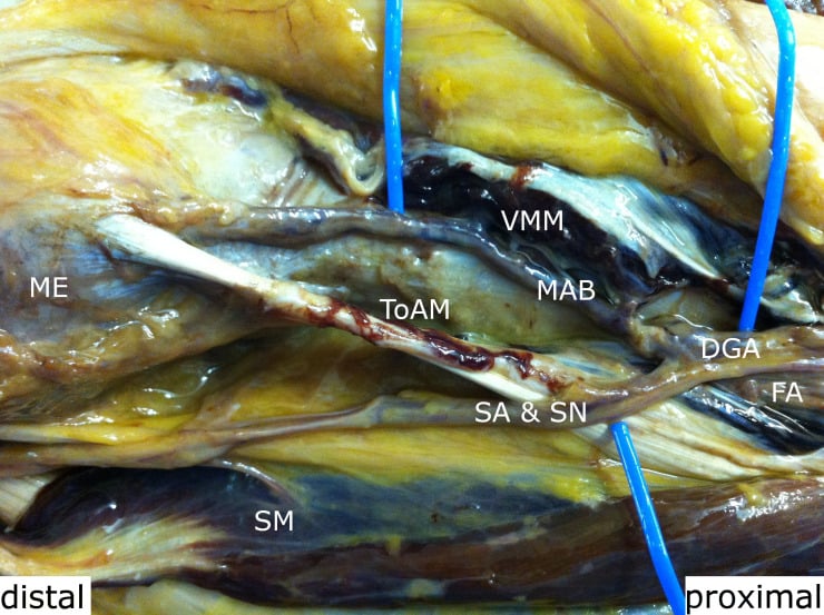 Cadaveric medial distal-thigh dissection showing the descending genicular artery, saphenous artery, saphenous nerve and sartorius muscle.
