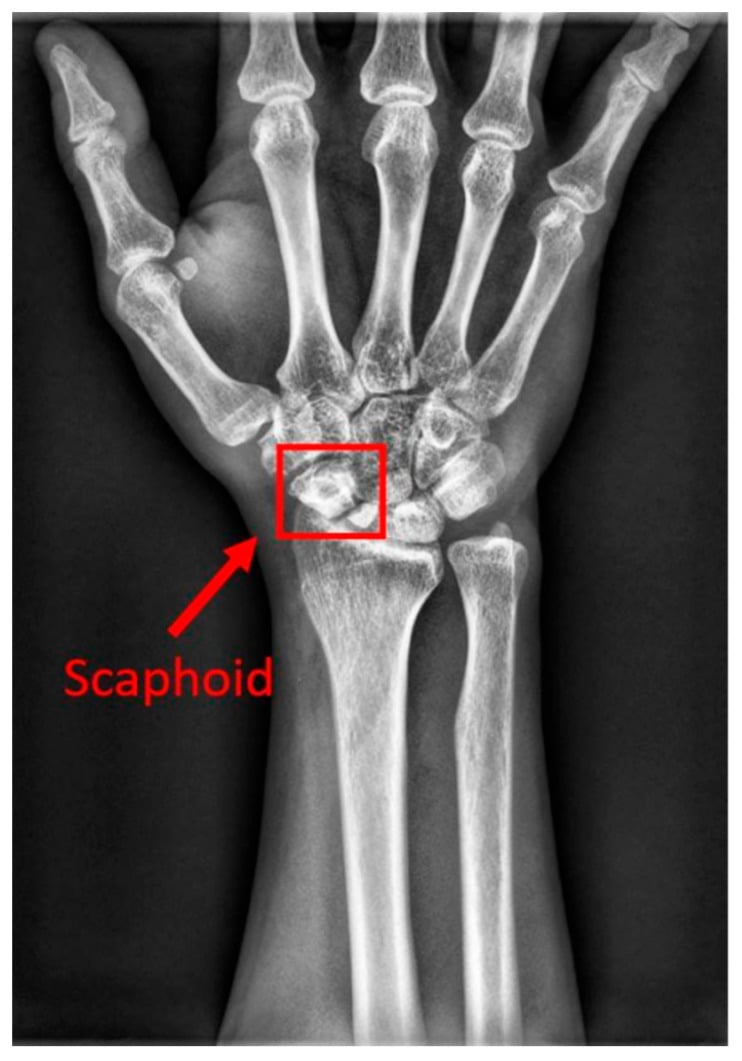 PA radiograph of wrist showing scaphoid fracture with scaphoid bone highlighted