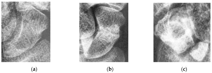 Multiple radiographic views of scaphoid fractures