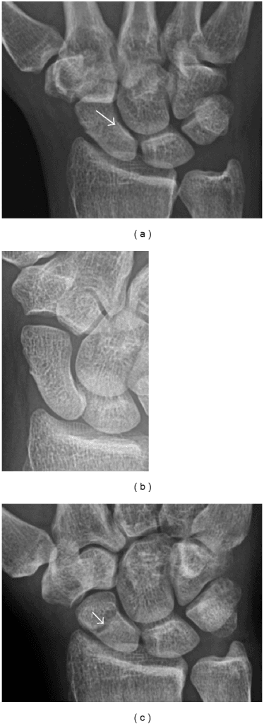Radiographs of a radiographically occult scaphoid fracture, with arrows marking a subtle linear lucency.