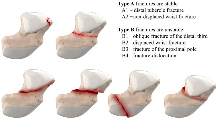 Herbert Classification of scaphoid fractures showing Type A stable and Type B unstable patterns