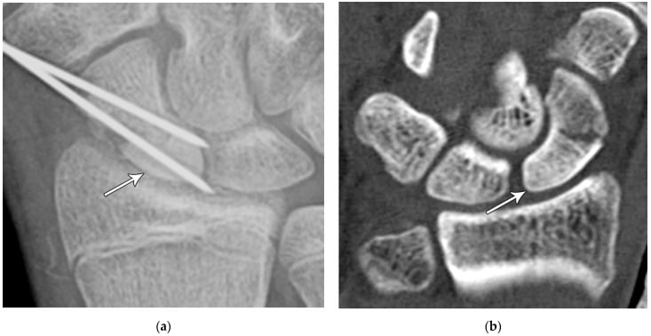 AVN sclerosis of proximal pole scaphoid on X-ray and CT