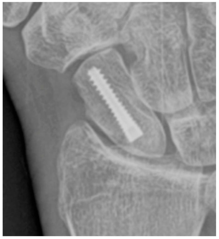 PA radiograph showing Herbert screw fixation of scaphoid fracture
