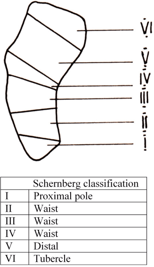 Schernberg scaphoid location classification schematic showing proximal-pole, waist, distal-pole and tubercle zones.