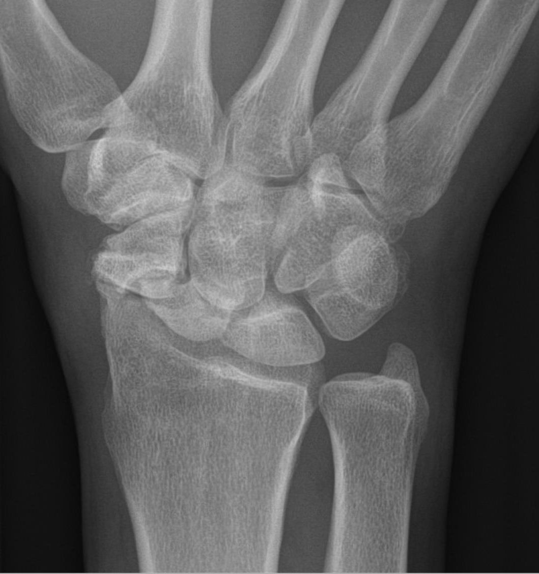PA wrist radiograph showing an established scaphoid waist nonunion: a lucent gap with sclerotic margins across the scaphoid waist.