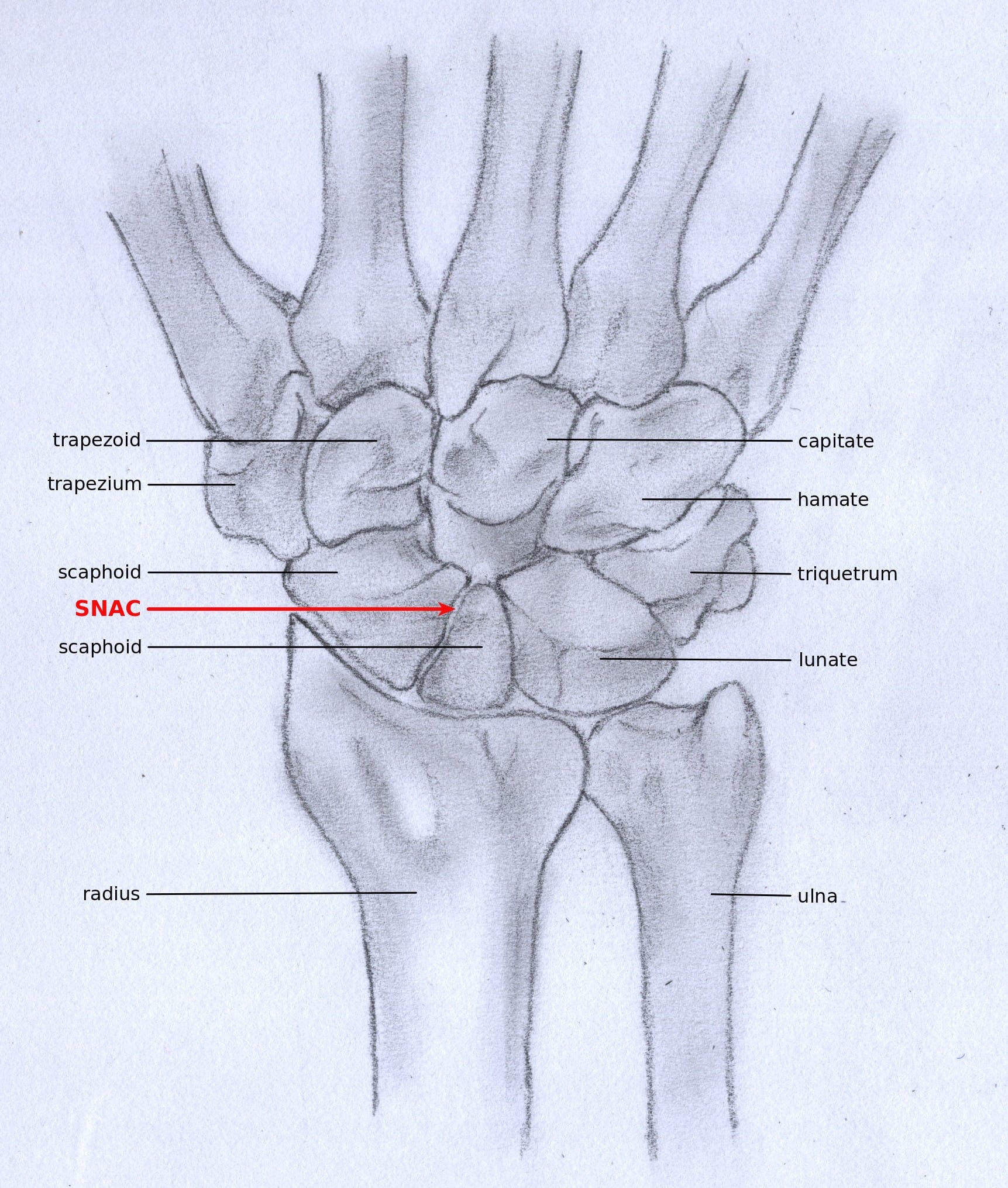 Labelled illustration of the carpal bones with the scaphoid nonunion (SNAC) site marked