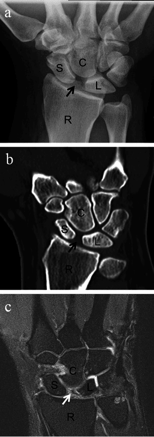 Scapholunate dissociation on a PA radiograph, coronal CT and coronal MRI, each showing widening of the scapholunate interval with the scaphoid, capitate, lunate and radius labelled.
