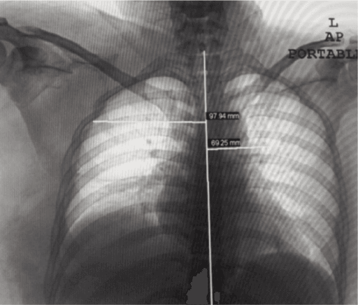 AP chest radiograph demonstrating scapulothoracic dissociation with scapula index measurement