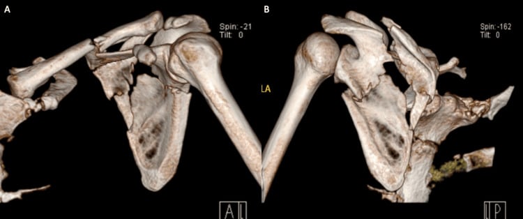 Three-dimensional CT reconstruction showing ipsilateral clavicle and scapular neck fractures in a floating shoulder injury.