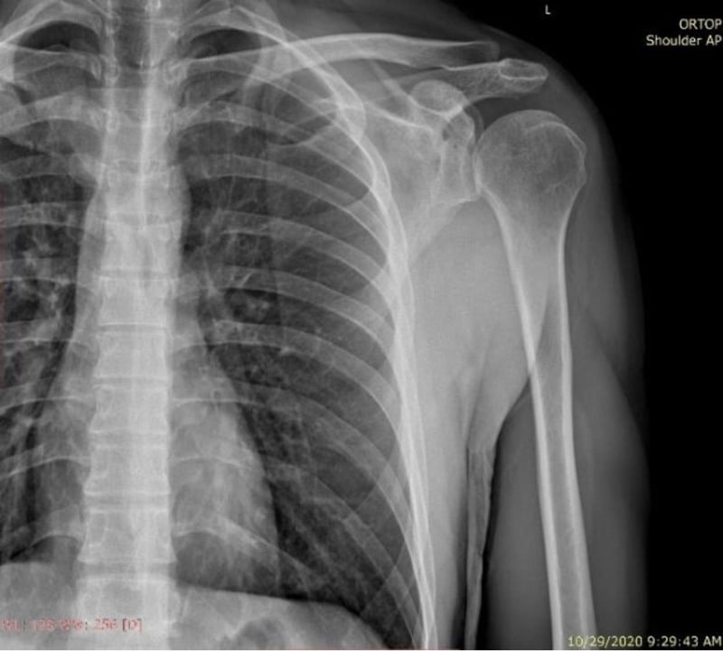 Anteroposterior shoulder radiograph at two years after open reduction and internal fixation of a complex glenoid fracture.