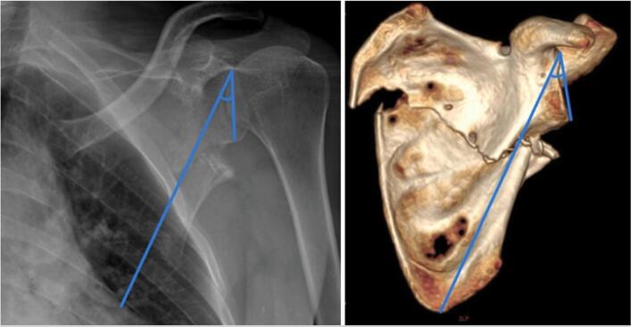 Glenopolar angle measured on an anteroposterior shoulder radiograph and a three-dimensional CT reconstruction.
