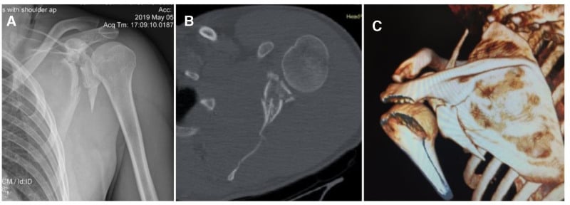 Anteroposterior radiograph and axial, sagittal and three-dimensional CT images of a complex Ideberg type Vb glenoid fracture.