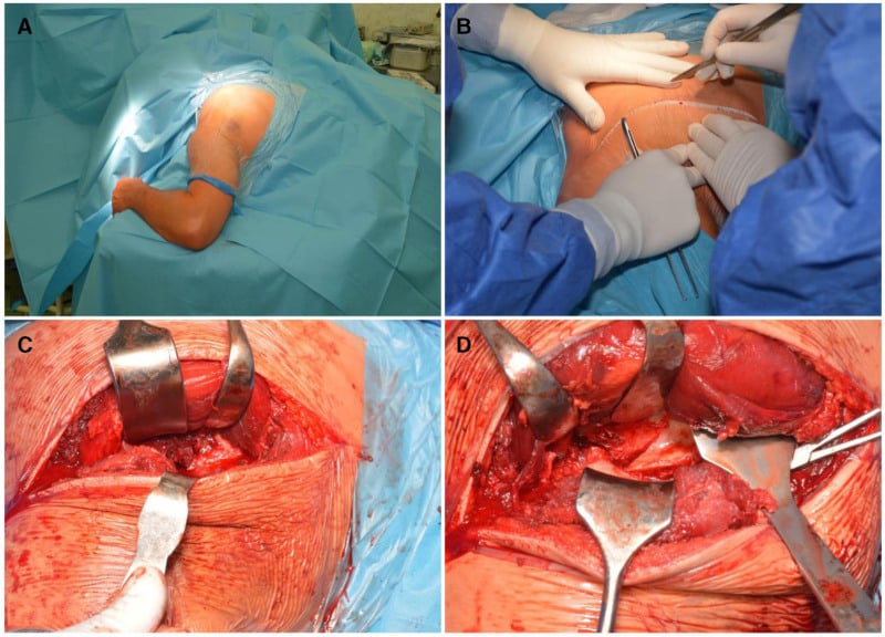 Intraoperative sequence of a modified Judet approach showing the posterior incision and internervous windows around infraspinatus and teres minor.