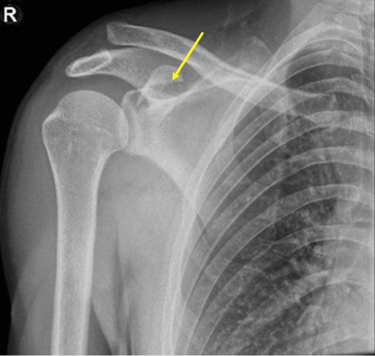Anteroposterior shoulder radiograph showing a displaced coracoid base fracture with acromioclavicular joint disruption.