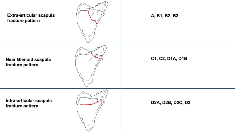 Representative extra-articular, near-glenoid and intra-articular scapular fracture patterns with preoperative and postoperative radiographs.