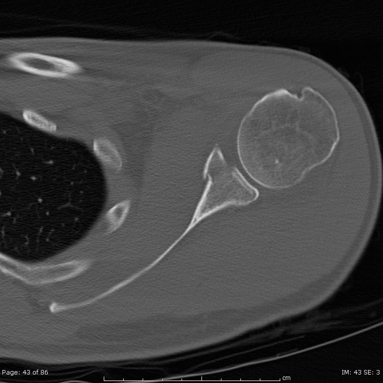 Axial CT through the left shoulder showing a scapular and glenoid fracture.