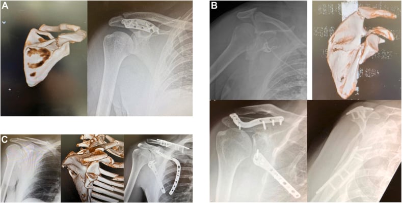Preoperative and postoperative imaging of extra-articular, near-glenoid and intra-articular scapular fracture fixation.