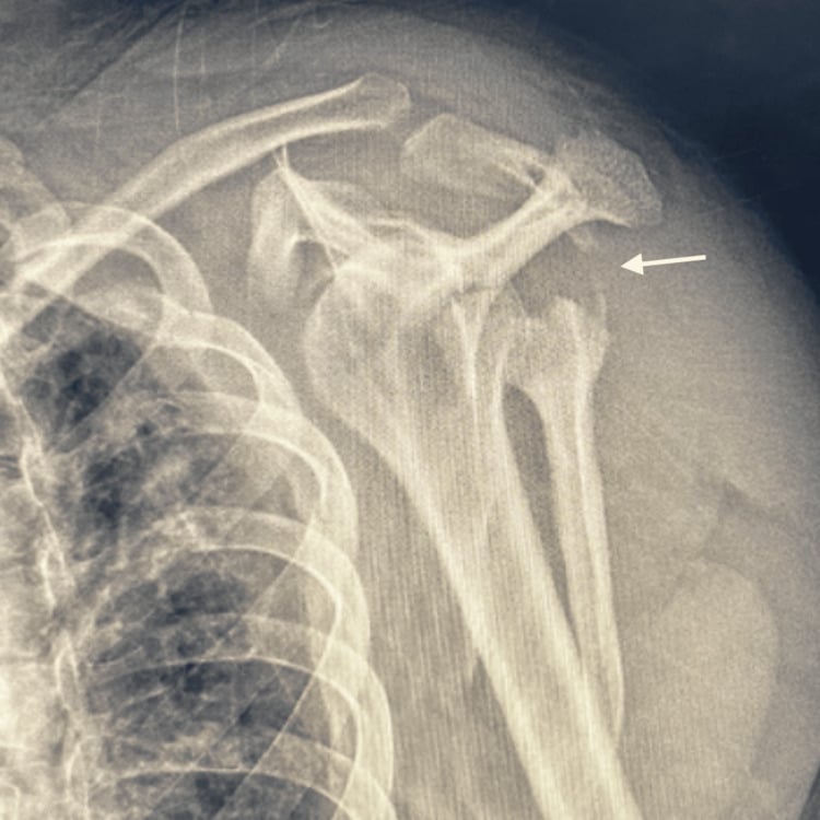 Scapular Y radiograph showing a multifragmentary fracture of the scapular body and glenoid region.