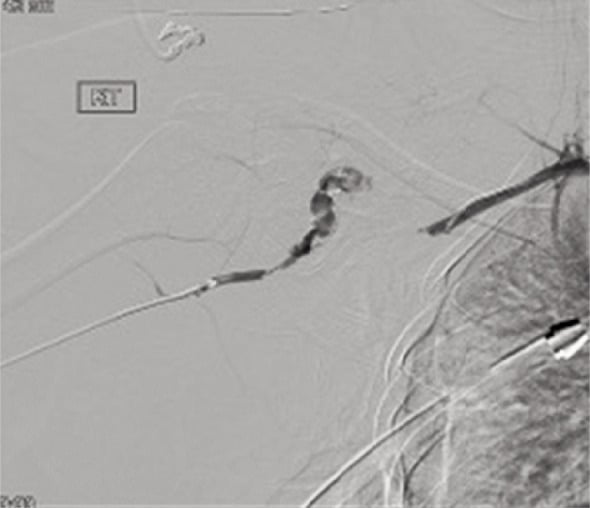 CT angiography demonstrating a long-segment subclavian artery avulsion with contrast extravasation after scapulothoracic dissociation.