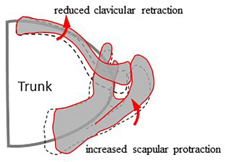Schematic of the clavicle and scapula on the trunk, a red outline against a dashed one, labelled reduced clavicular retraction and increased scapular protraction