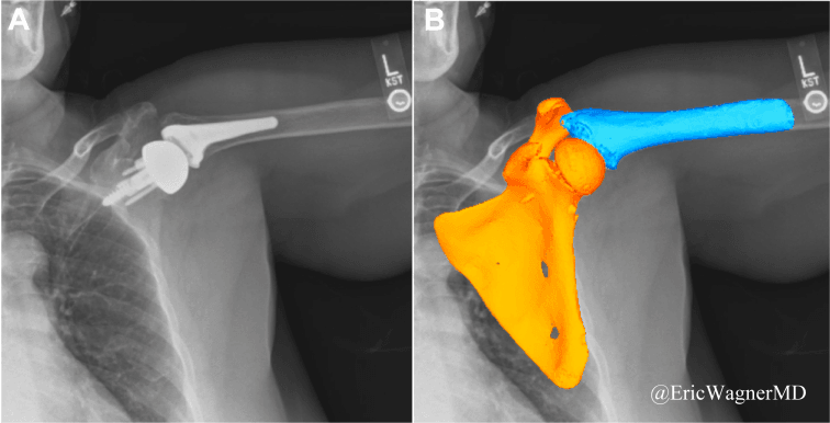 Radiograph of a shoulder replacement (A) and the same view with three-dimensional scapula and humerus models registered to it (B)