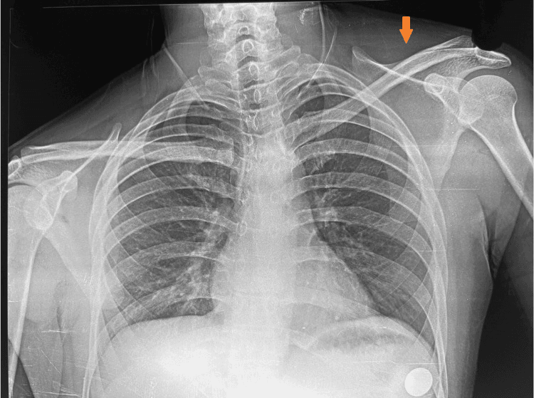 Chest radiograph with an arrow marking an elevated left scapula