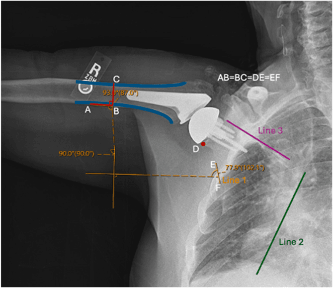 Radiograph of an elevated arm with a shoulder replacement, marked with points A to F and Lines 1 to 3 for scapulohumeral rhythm measurement
