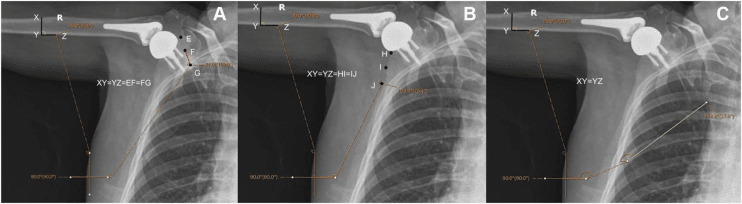 Three radiograph panels, A to C, each marking a different scapular reference line for the scapulothoracic angle