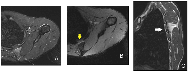 Three MRI panels with arrows marking a ventral scapular osteochondroma between the scapula and the ribs