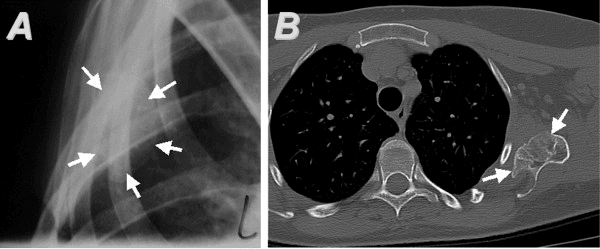Radiograph and axial CT with arrows marking a ventral scapular osteochondroma