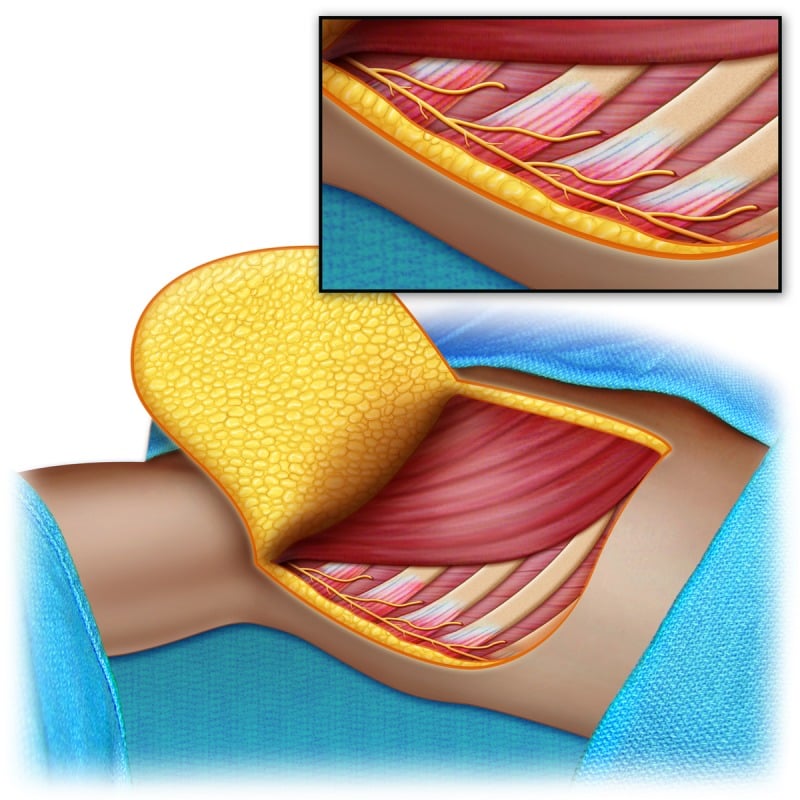 Anatomical schematic of intercostal nerve branches transferred to the long thoracic nerve on the lateral chest wall.