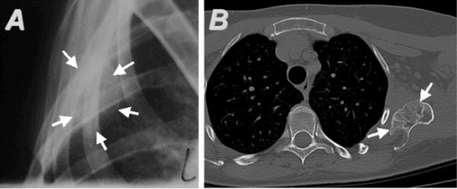 Lateral scapular radiograph and axial CT showing a ventral scapular osteochondroma marked by arrows.