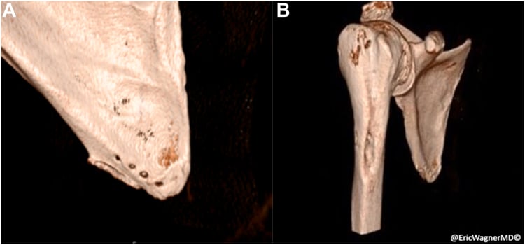 Postoperative three-dimensional CT reconstructions showing an osteointegrated pectoralis major humeral bone plug fixed to the inferior scapula.