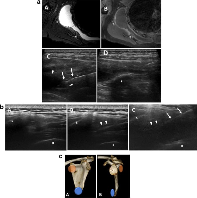 MRI and ultrasound montage showing a scapulothoracic bursal effusion associated with osteochondroma and ultrasound-guided aspiration.