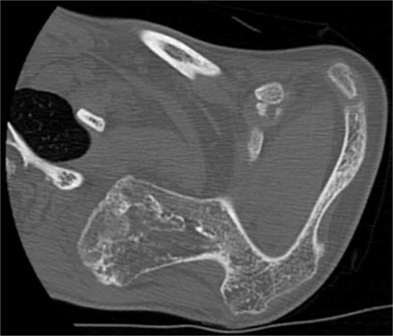 Axial CT showing a large osteochondroma arising from the ventral superior angle of the scapula.