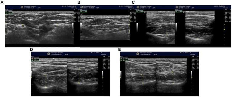 Bilateral high-resolution ultrasound comparison showing swelling of the symptomatic suprascapular nerve at its origin and notch.