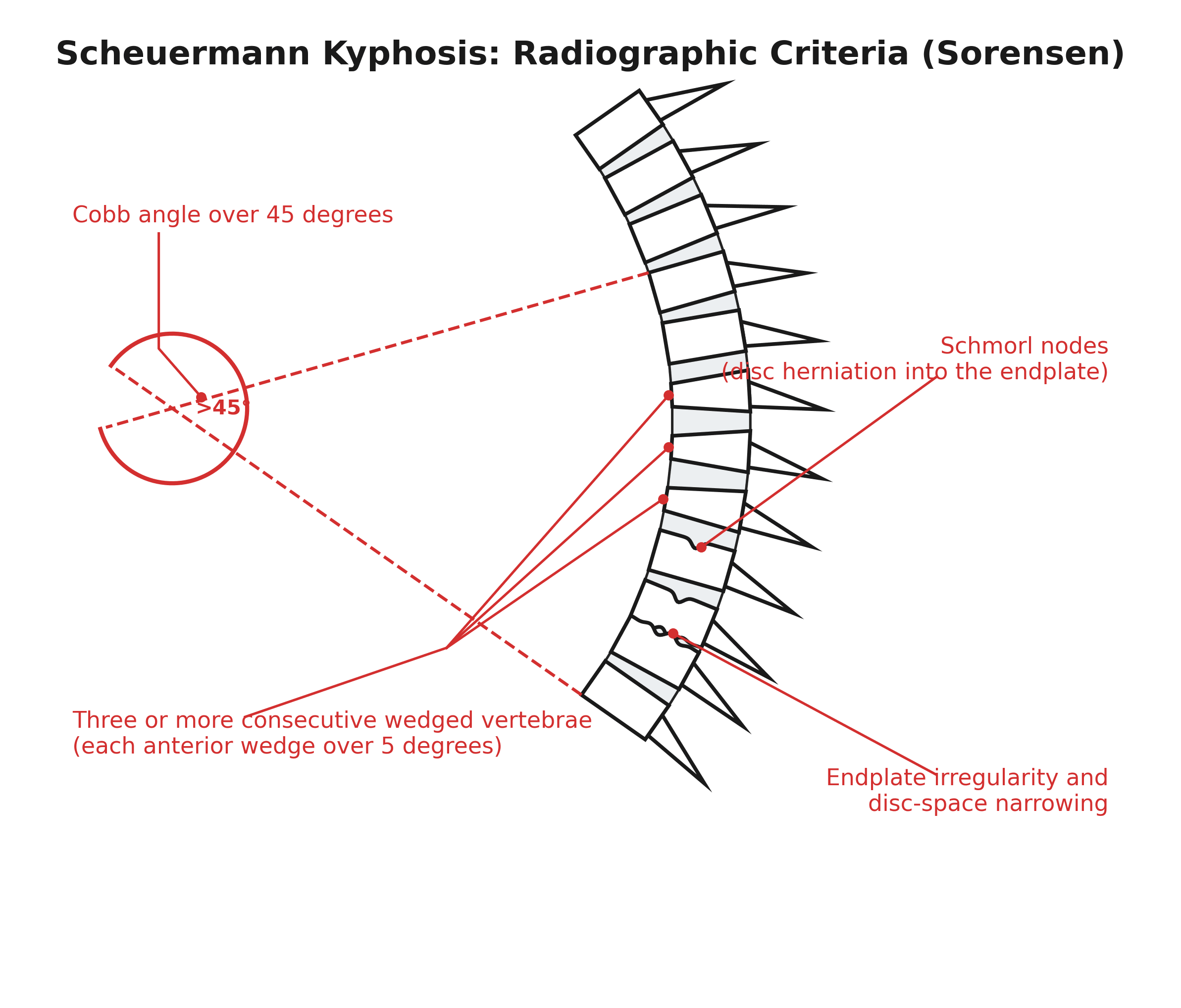 Diagram of the radiographic diagnostic criteria of Scheuermann kyphosis on a lateral thoracic spine