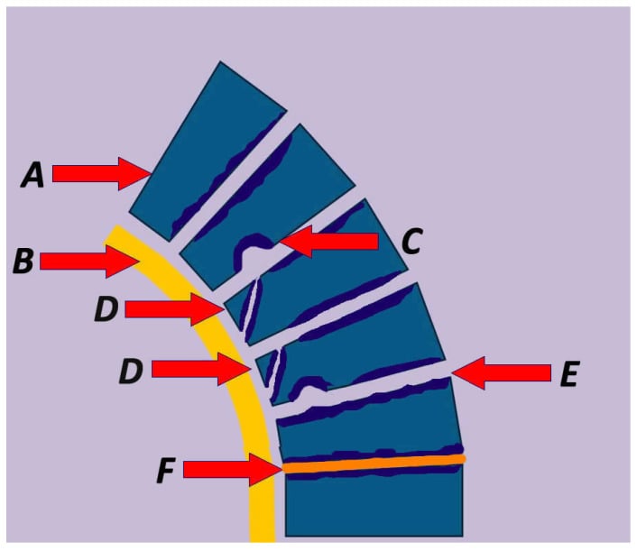 Diagram of the pathophysiological lesions of Scheuermann kyphosis - wedging, endplate change, Schmorl nodes