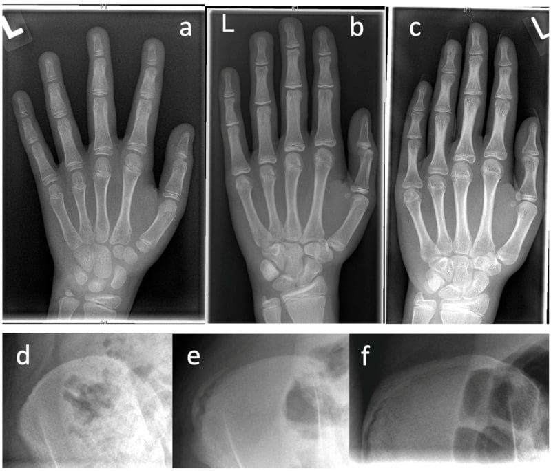 Hand and pelvic radiographs for Sanders and Risser growth staging