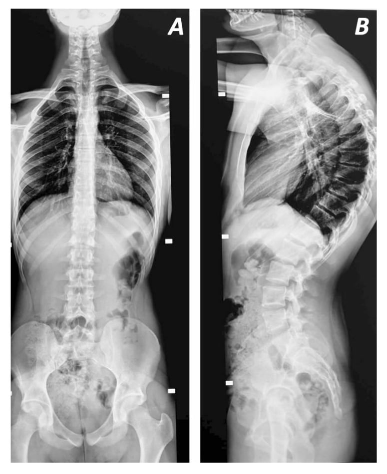 Anteroposterior and lateral radiographs of a 77-degree kyphotic deformity