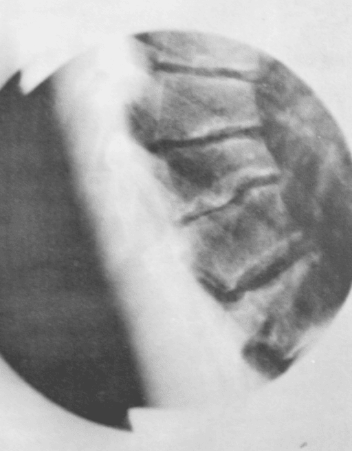 Lateral radiograph showing the characteristic late-stage findings of Scheuermann disease