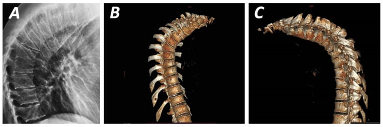 Lateral radiograph and 3D CT showing anterior wedged vertebral bodies