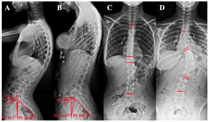 Radiograph with pelvic incidence, pelvic tilt and sacral slope measured