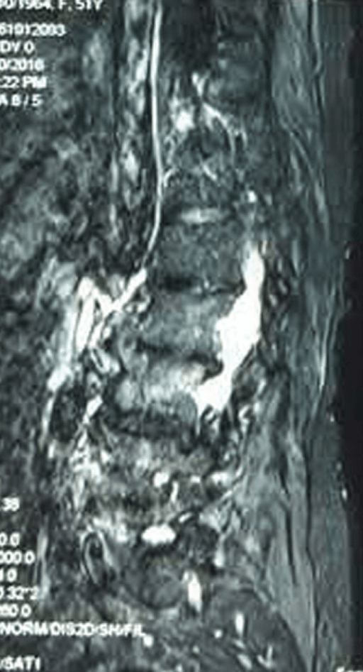 Full-spine standing radiographs with sagittal alignment parameters