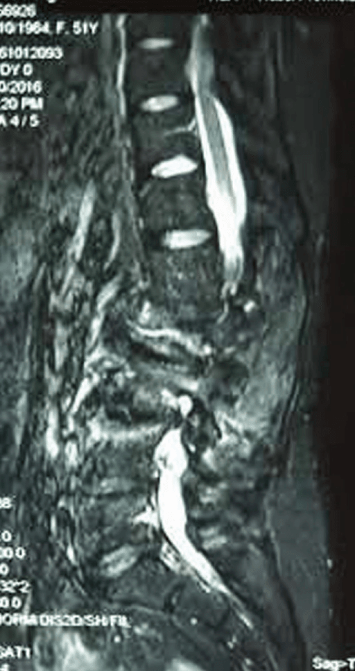 Sagittal lumbar MRI excluding neural compression