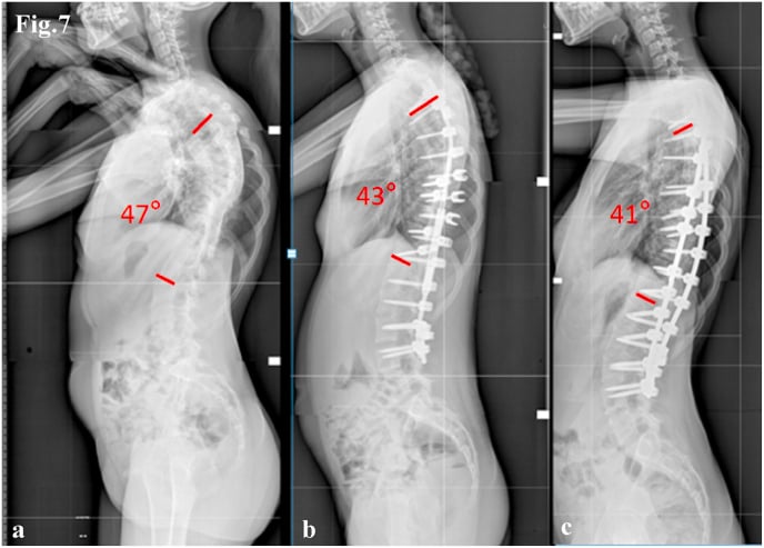Serial lateral radiographs through staged correction and definitive fusion